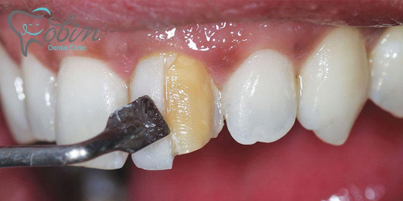 بهتر است بدانید نخ دندان از بیماری لثه جلوگیری می کند